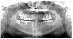Есть ли патология зубов на рентгеновском снимке? фото 1