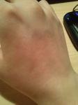 Шелушится кожа на руке, контактный аллергический дерматит фото 2