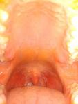 Постоянное воспаление в горле фото 2