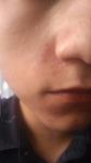 Себорейный дерматит на лице в районе носа у 18летнего парня фото 3