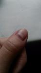 Вдавленность и трещины у основания ногтя фото 1