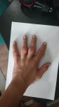 Образования на пальцах фото 1