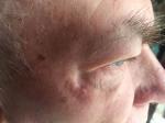 Возможность лечения многолетнего нароста на коже у глаза фото 2