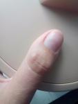 Бугорок на пальчике (на руке) фото 1