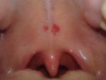 Красное пятно во рту, t 38, неприятные ощущения в горле фото 1