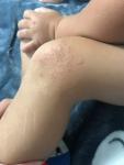 Сыпь у ребёнка на коленке фото 1
