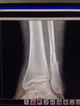 Рентген перелома ноги консультация фото 1