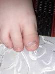 Слоение ногтей ног у ребёнка фото 2