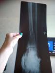 Перелом дистального отдела большеберцовой кости закрытый перелом (снимки) фото 1
