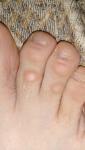Бугорки на пальцах ног фото 1