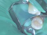 Микротрещина в зубе фото 1