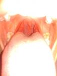 Постоянное воспаление в горле фото 3