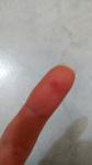 Красная точка на подушечке пальца фото 1