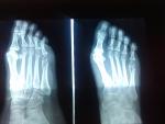 Перелом 5 плюсневой кости левой ноги фото 1