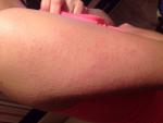 Аллергия уже 2 месяца не проxодит сыпь по всему телу фото 2