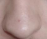 Красная точка на носу, не проходит 2 года фото 2