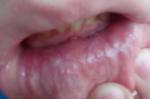 Пупыри во рту, частые стоматиты и раздражение слизистой фото 1