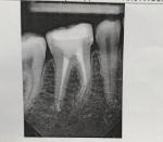 Болит зуб после удаления нерва и пломбировки каналов фото 1