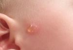 Видоизменяющееся пятно на лице у ребенка фото 4
