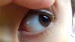 Пятна на глазном белке у девочки 3.5 года фото 2