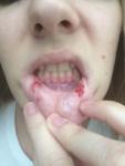 Кровоизлияния на слизистой рта фото 1