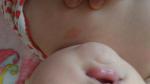 Красное пятно на шее у ребенка 6 месяцев не проходит фото 1