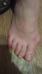 Воспаление пальца на ноге фото 3