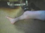 ДЦП права нога кородша та тонша погано розвинуті мязи ноги фото 1