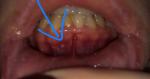 Ямка на нижней челюсти под зубом фото 2