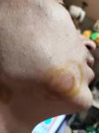 Шелушение и твердые шишки на лице, похожие на прыщ фото 2