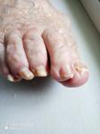 Что делать и чем лечить грибок ногтей на ноге фото 1