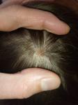Пятно на волосистой части головы фото 1