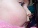 Сыпь у ребенка на щеке 8месяцев фото 1