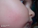 Сыпь у ребенка на щеке 8месяцев фото 2
