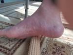 Перелом голени, стопа, краснеет нога фото 1