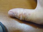 Воспаление на большом пальце руки фото 1