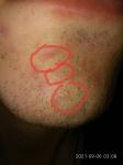 Как окончательно избавиться от гипертрофических шрамов на лице? фото 3