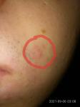 Как окончательно избавиться от гипертрофических шрамов на лице? фото 4