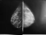 Уточнение диагноза после маммографии фото 2