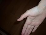 Шелушение и трещины на большом и указательном пальце фото 1