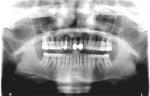 Панорама зубов и смена коронки фото 1
