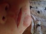 Сыпь на лице у ребенка в виде прыщиков 1 месяц фото 5