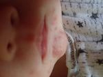 Сыпь на лице у ребенка в виде прыщиков 1 месяц фото 1