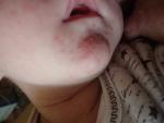 Сыпь на лице у ребенка в виде прыщиков 1 месяц фото 3