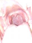 Ощущение инородного тела в горле фото 3