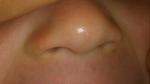 Пузырьковая сыпь на носу у ребёнка фото 1