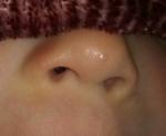 Пузырьковая сыпь на носу у ребёнка фото 2