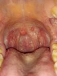 Воспаление слизистой рта фото 2