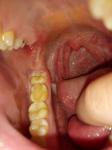 Воспаление слизистой рта фото 1
