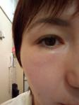 Аллергические шишки на лице и по телу фото 1